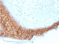 Formalin-fixed, paraffin embedded human basal cell carcinoma sections stained with 100 ul anti-TROP2 (clone TACSTD2/2153) at 1:200. HIER epitope retrieval prior to staining was performed in 10mM Citrate, pH 6.0.